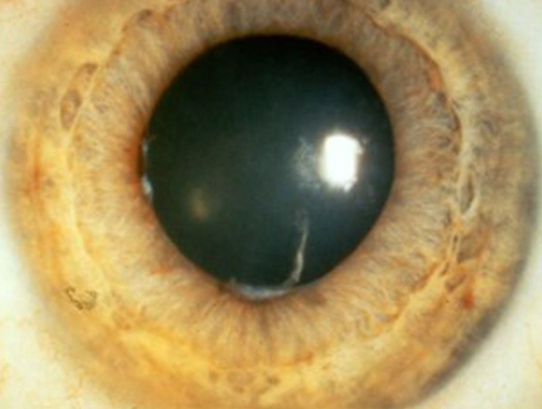 Nahmaufnahme eines Auges mit Uveitis