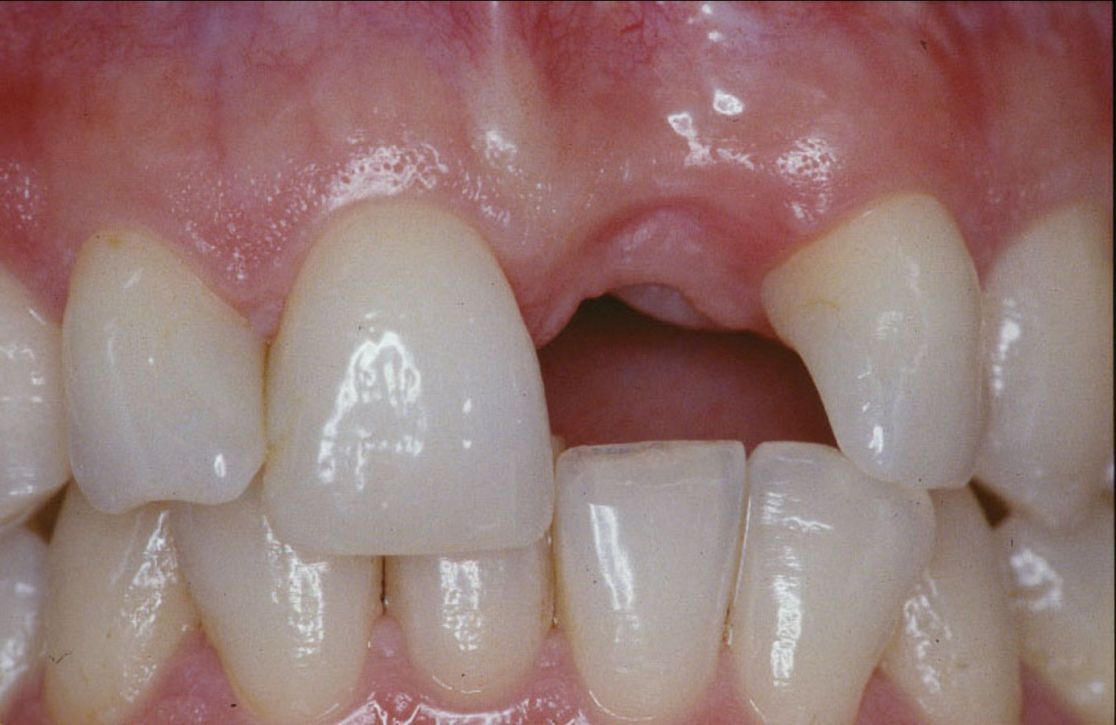 Abbildung eines Mundes mit einem fehlenden Schneidezahn vor der Implantation