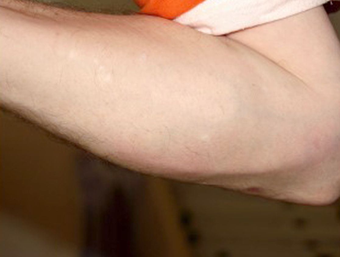 Aufnahme eines Unterarms mit Schwellung
