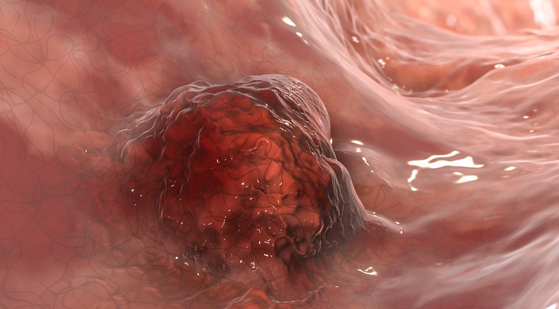 Tumor im Darm