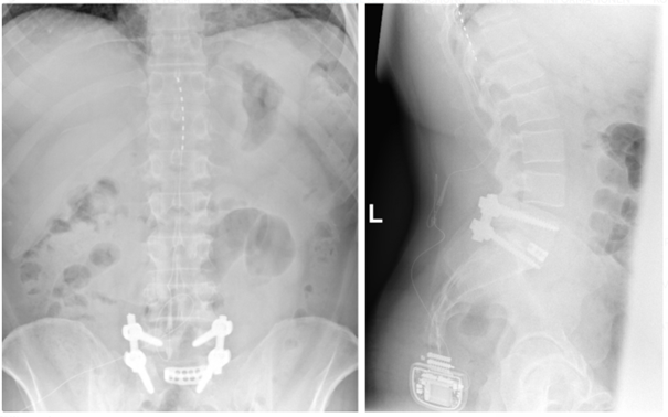 Röntgenbild zur Rückenmarkstimulation