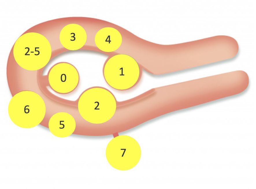 Abb. 3: Myomklassifikation