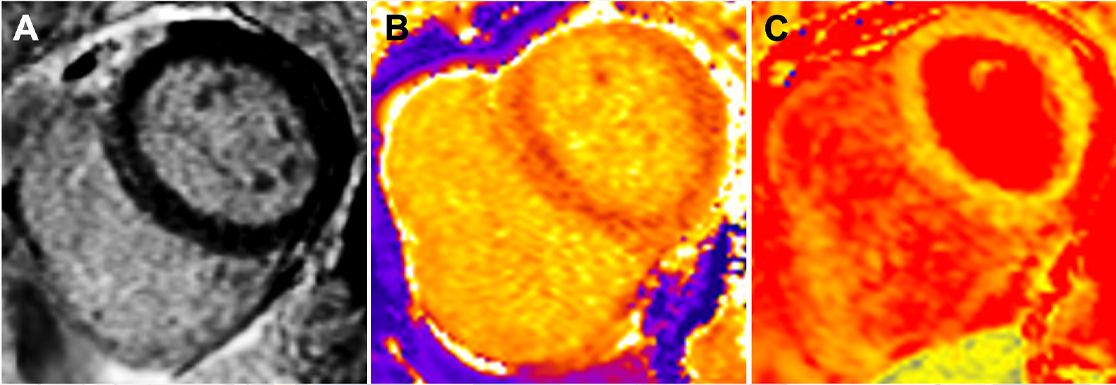 MRT Aufnahme mit Mapping Verfahren