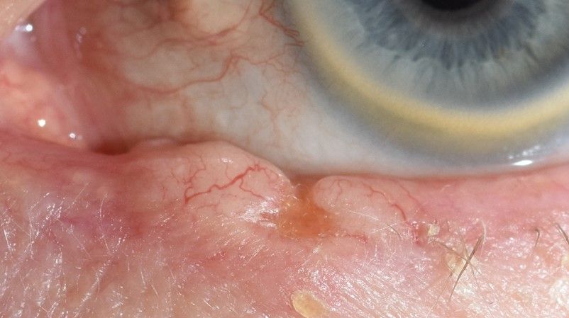 Bösartiger Lidtumor Unterlid (Basaliom)