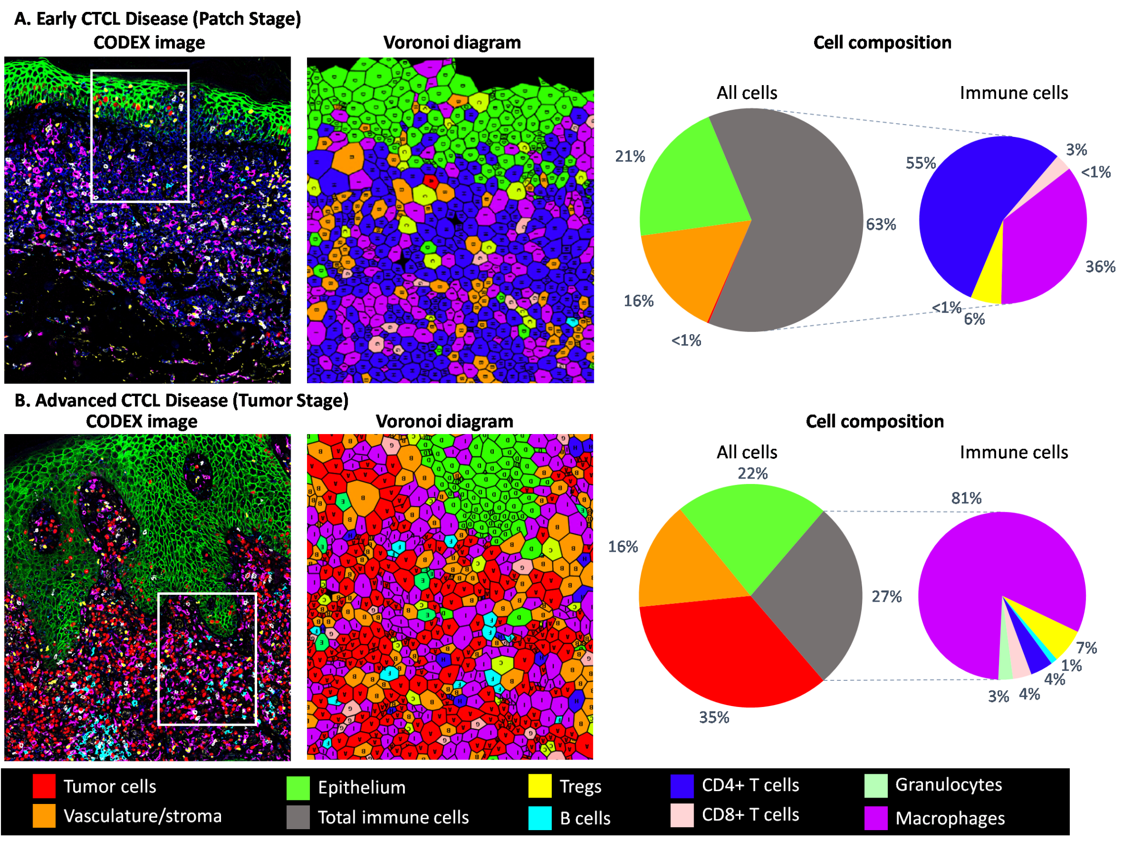 CODEX zeigt die Zusammensetzung des TME bei CTCL. (A) Patch- und (B) Tumorstadium.