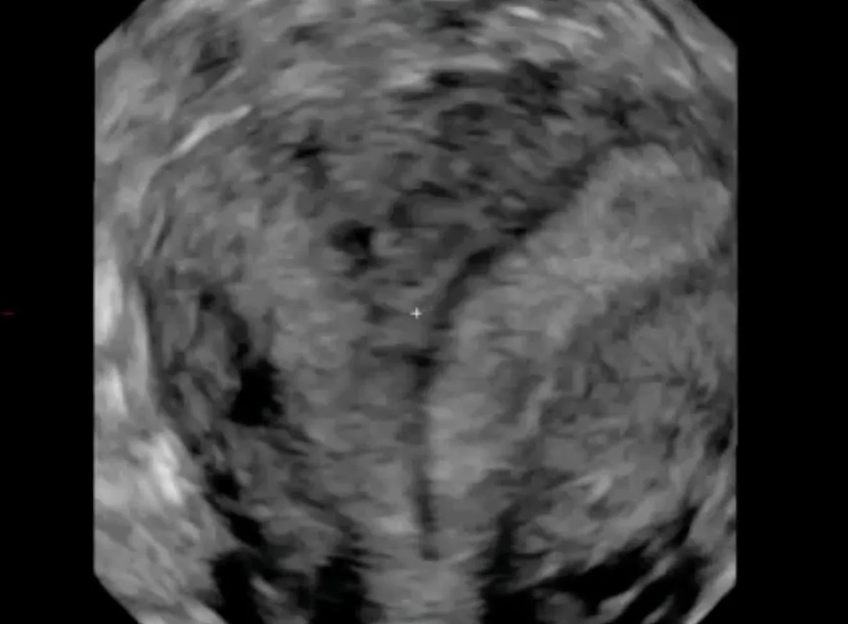 Uterus septiert
