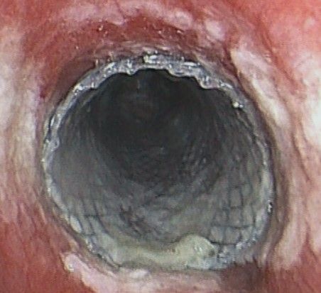 Bronchi