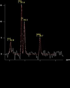 Intraoperative Darstellung der chemischen Zusammensetzung von Tumorgewebe im MRT (Spektroskopie)