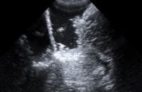 Ultraschallbild während Resektion