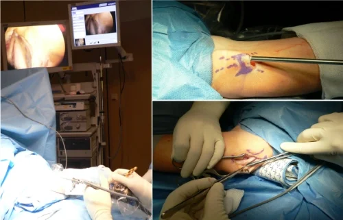 Abbildung: links + rechts oben: endoskopische Operation, rechts unten: offene Operation