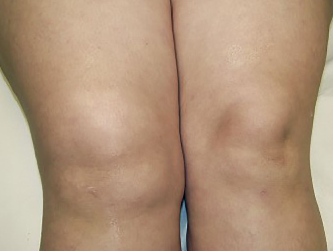 Aufnahme zweier Knie, linkes Knie geschwollen