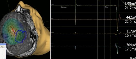 NTMS- Navigierte Transkranielle Magnetstimulation