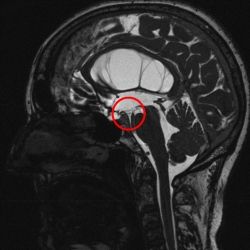 Präoperative MRT Untersuchung.