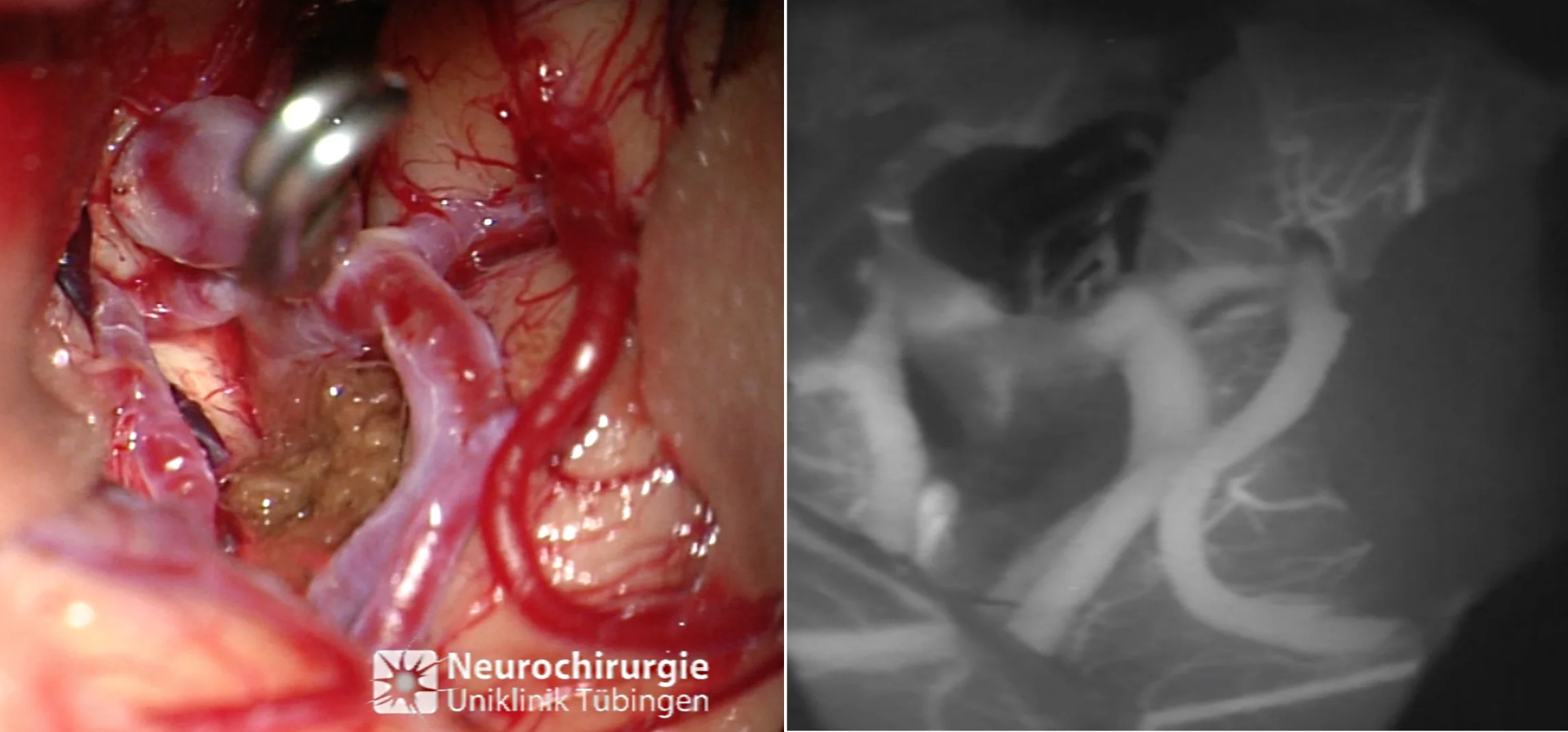 Foto eines geclippten Aneurysmas mit Weißlicht und während der „ICG-Angiographie“