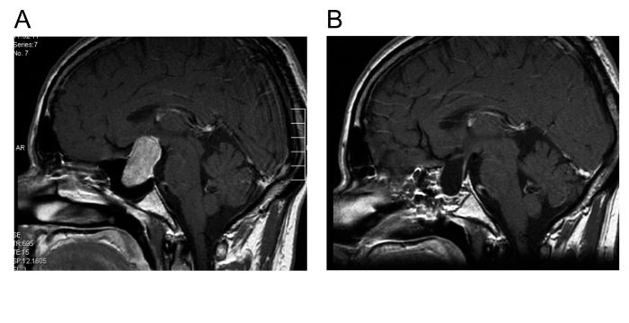 Links(A): Kernspintomographie eines großen intrasellären und suprasellären Hypophysenadenoms. Rechts(B): Die postoperative Kernspintomographie bestätigt die vollständige Entfernung des Hypophysenadenoms. 