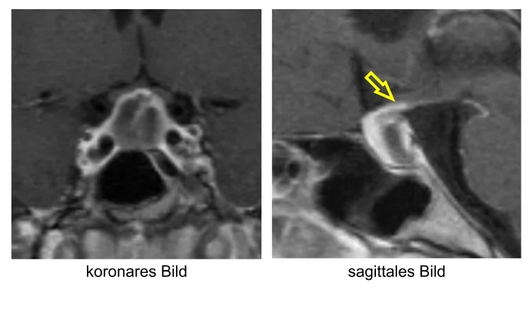 Die Kernspintomographie zeigt eine Hypophysitis. Links: Koronare Schnittführung. Rechts: Bei sagittaler Schnittführung ist eine Verdickung des Hypophysenstiels (gelber Pfeil) als charakteristisches Zeichen einer Hypophysitis zu sehen.