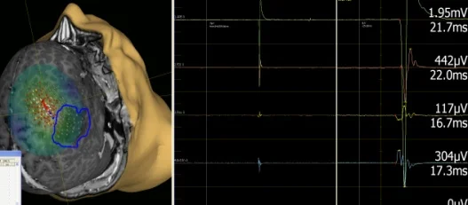 NTMS- Navigierte Transkranielle Magnetstimulation