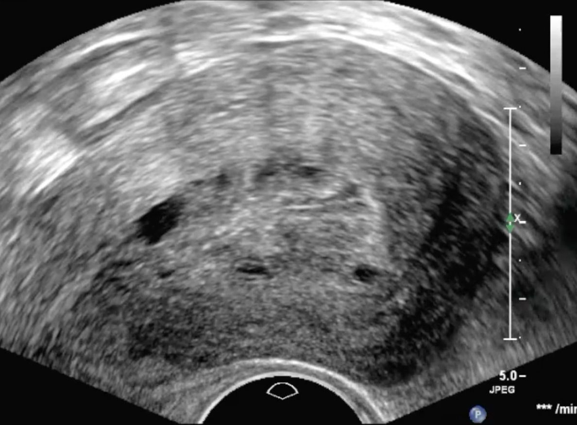 Adenomyosis