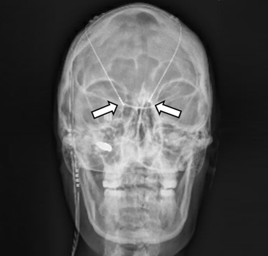 1. In das Gehirn implantierte Elektroden zur Tiefen Hirnstimulation (Pfeile)