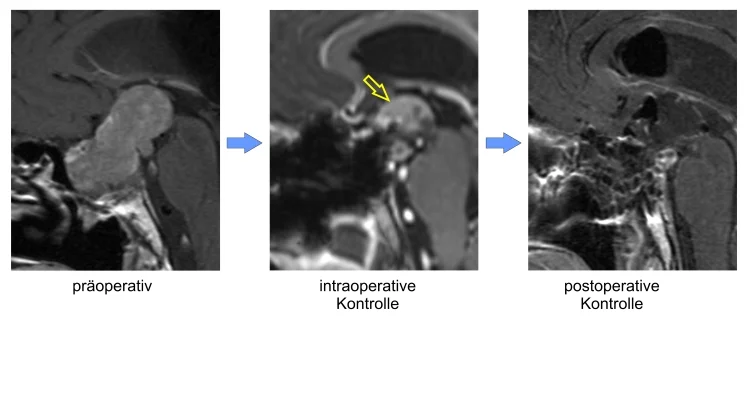 Großes Hypophysenadenom. Links: Präoperative Kernspintomographie. Mitte: Durch Verwendung der intraoperativen kernspintomographischen Kontrolle kann ein intrakranieller Tumor-Rest (gelber Pfeil) nachgewiesen und daraufhin noch während derselben Operation entfernt werden. Rechts: Die postoperative Kernspintomographie bestätigt die Entfernung des Resttumors.