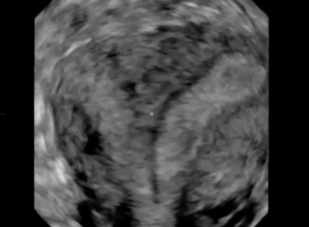 Uterus septiert