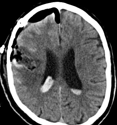 Bild einer intracerebralen Blutung nach OP.