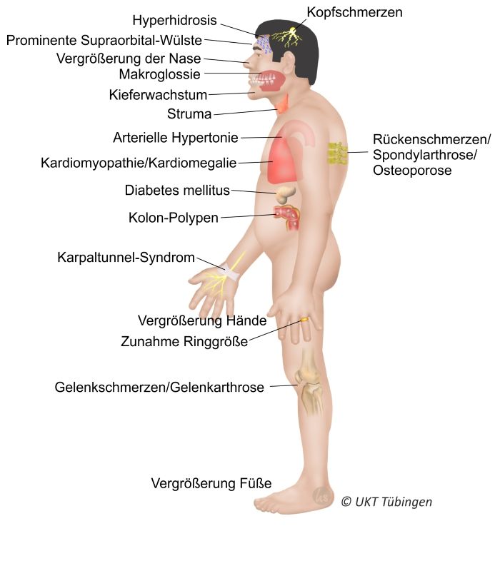  Abbildung 4: Schematische Darstellung typischer akromegaler Symptome. 