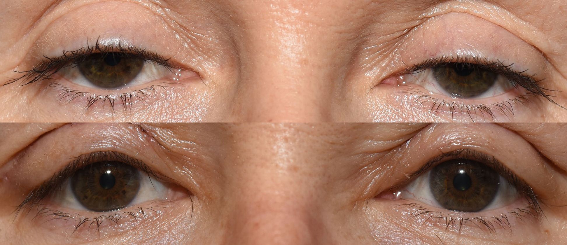 Vor und nach operativer Korrektur eines hängenden Oberlides (Ptosis) mit Einschränkung der Sehachse
