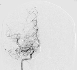 Angiografie einer Moymoya