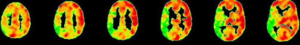 PET-CT nach Diamox Gabe