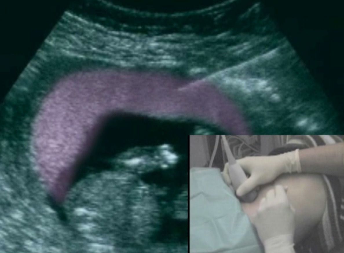 Mutterkuchenpunktion