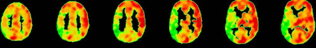 PET-CT nach Diamox Gabe