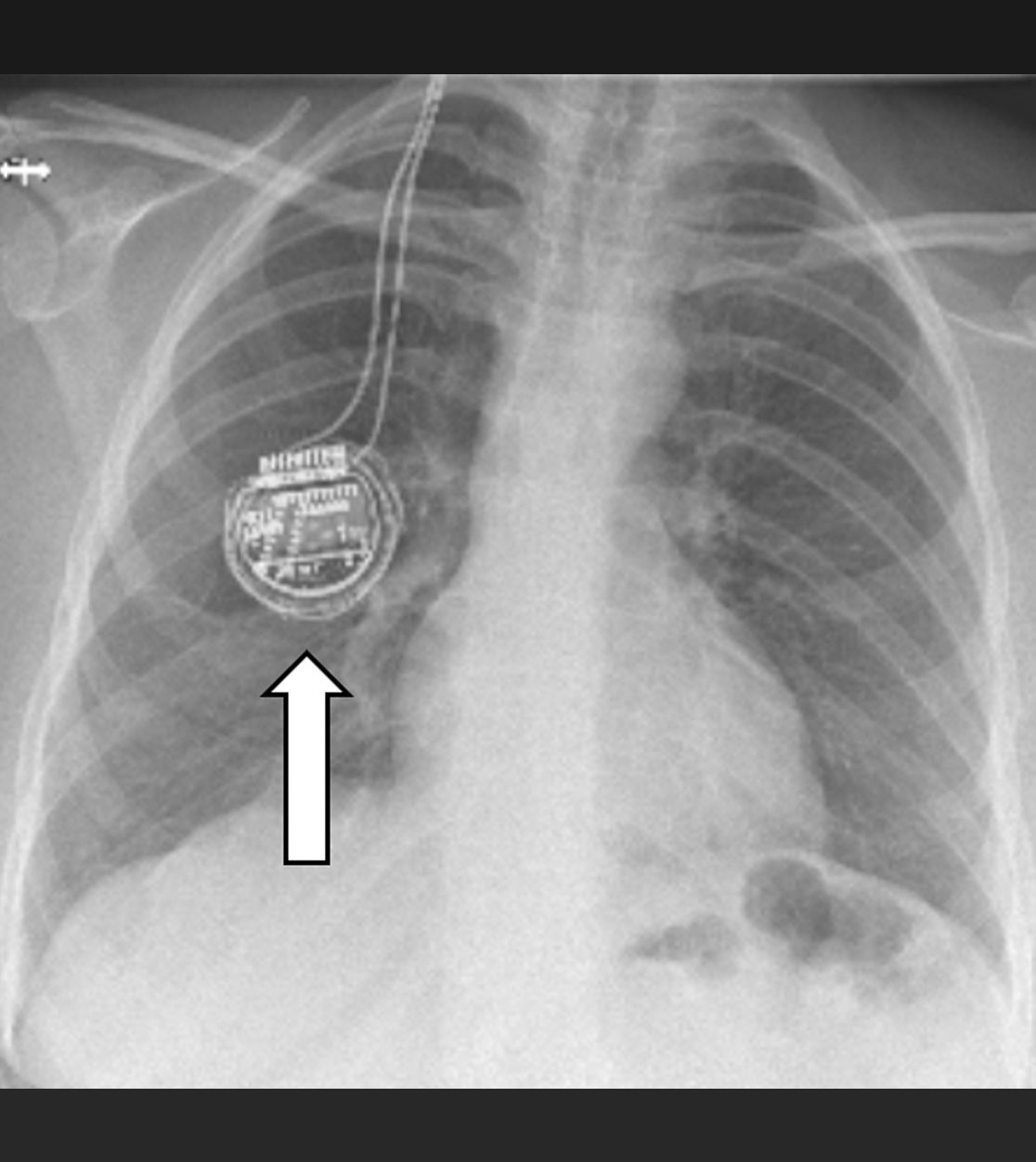 Impulsgeber im Bereich des Brustkorbs