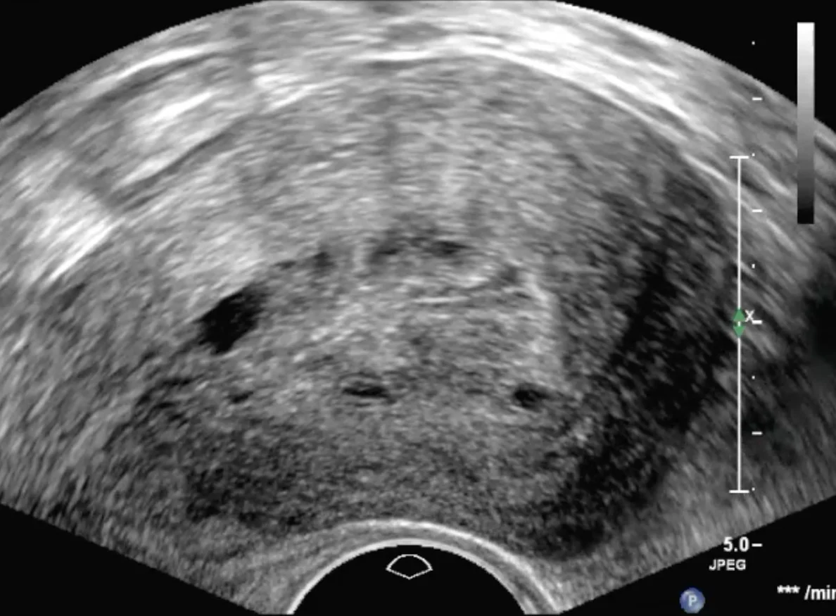Adenomyosis