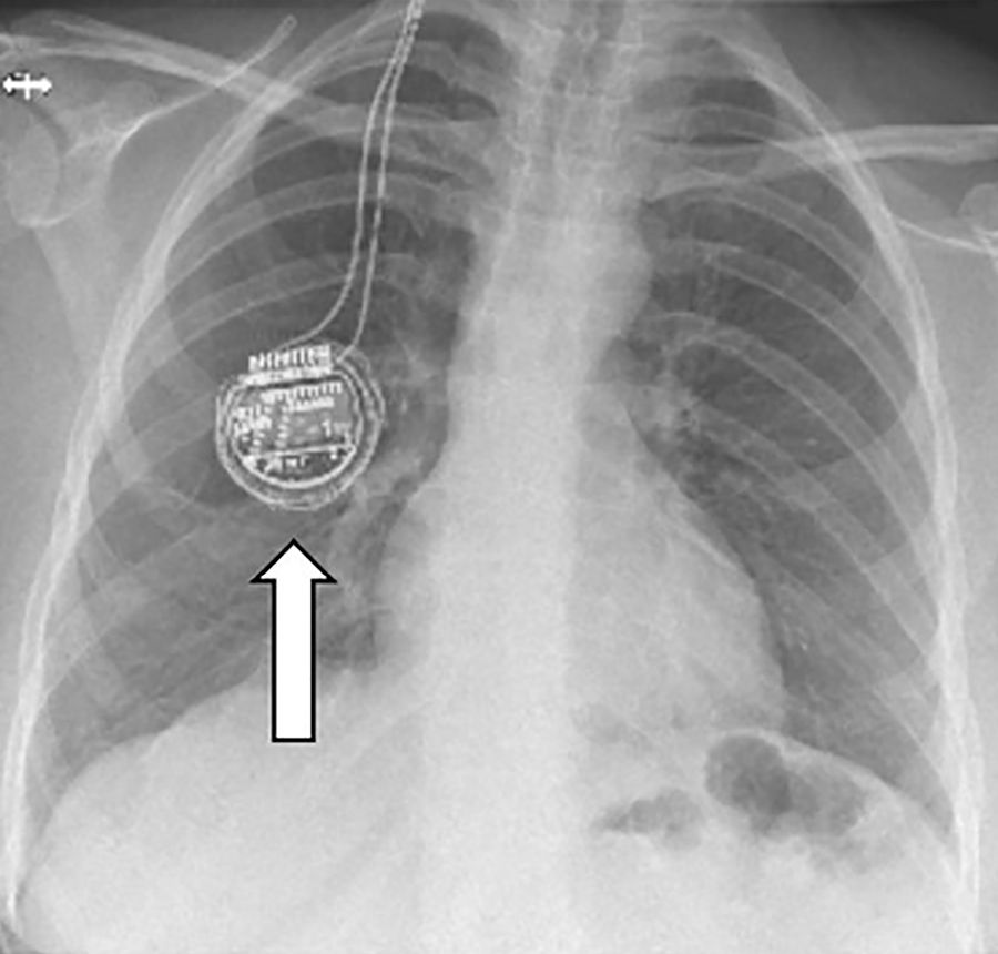 2.	Impulsgeber im Bereich des Brustkorbs