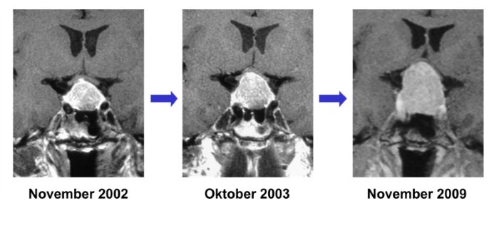 Abbildung 1: Die Kernspintomographien zeigen die Größenzunahme eines Hypophysenadenoms im zeitlichen Verlauf.