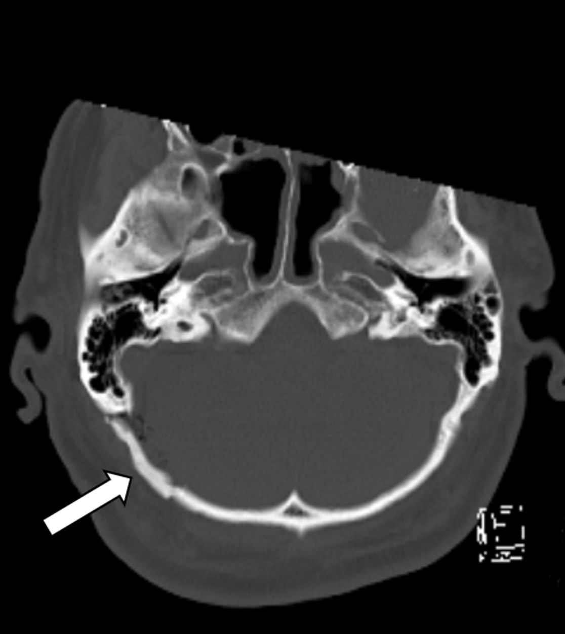 Status nach mikrovaskulärer Dekompression über einen Zugang hinter dem Ohr (Pfeil)