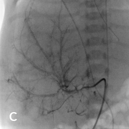 Wissenschaftliche Abbildung Leberhämangiom
