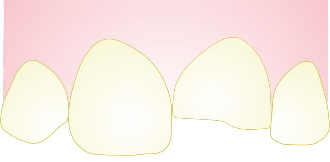 Drawing of a broken tooth