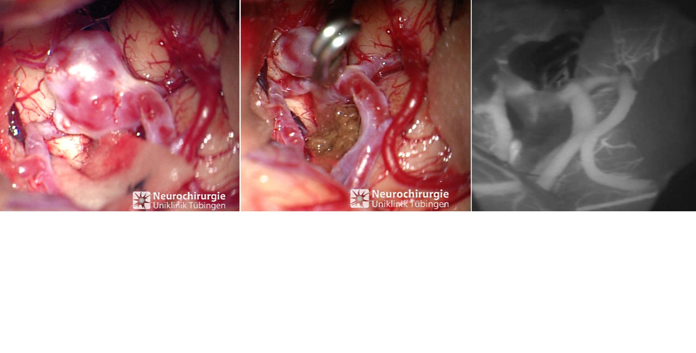 Intraoperatives Bild eines Aneurysmas