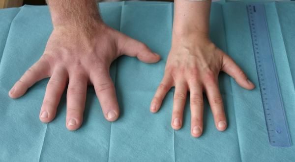 Zwei Hände vor grünem Hintergrund. Vergrößerte Hand links.