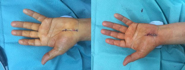 Hautschnitt und Naht bei CTS