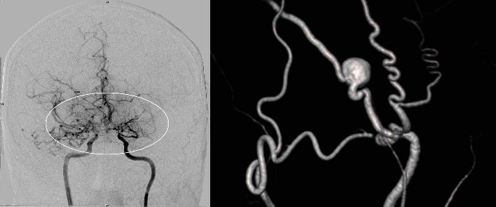 Angiographie beidseitige Moyamoya Krankheit