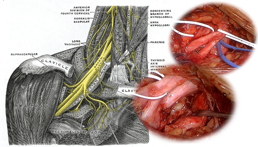 Wissenschaftliche Abbildung des Plexus brachialis, , Intra-Operative Bilder bei TOS