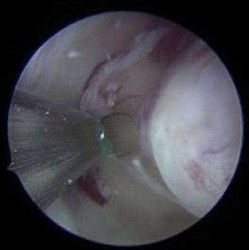 Abb. 4: Sicht auf eine submuköses Myom (unter der Gebärmutterschleimhaut) per Gebärmutterspiegelung