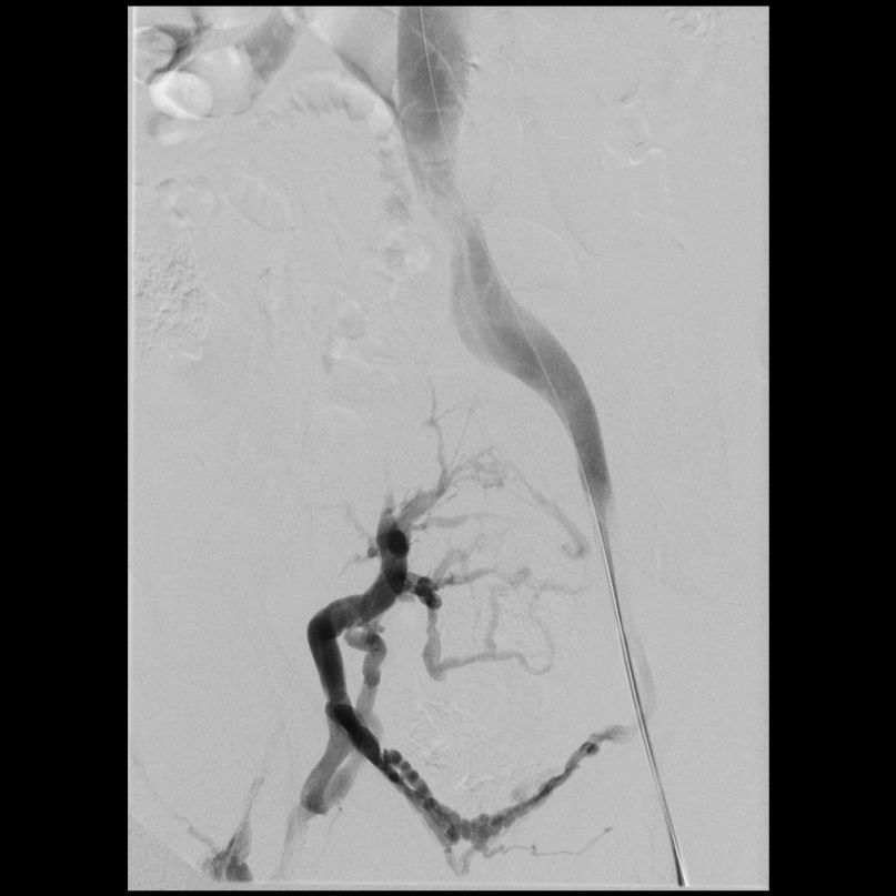 Venöse Intervention