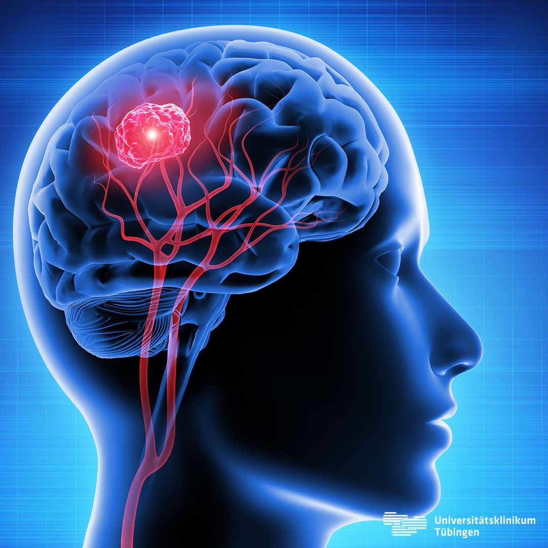 Glioblastom Gehirntumor