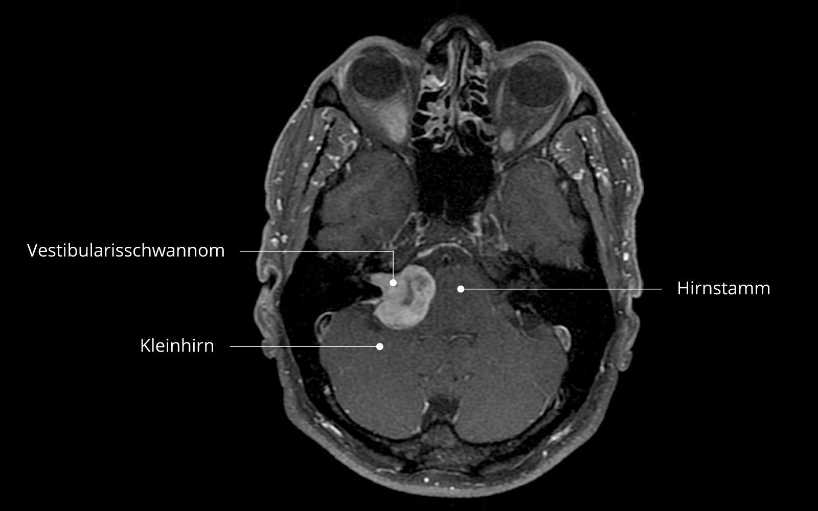 Vestibularisschwannom MRI