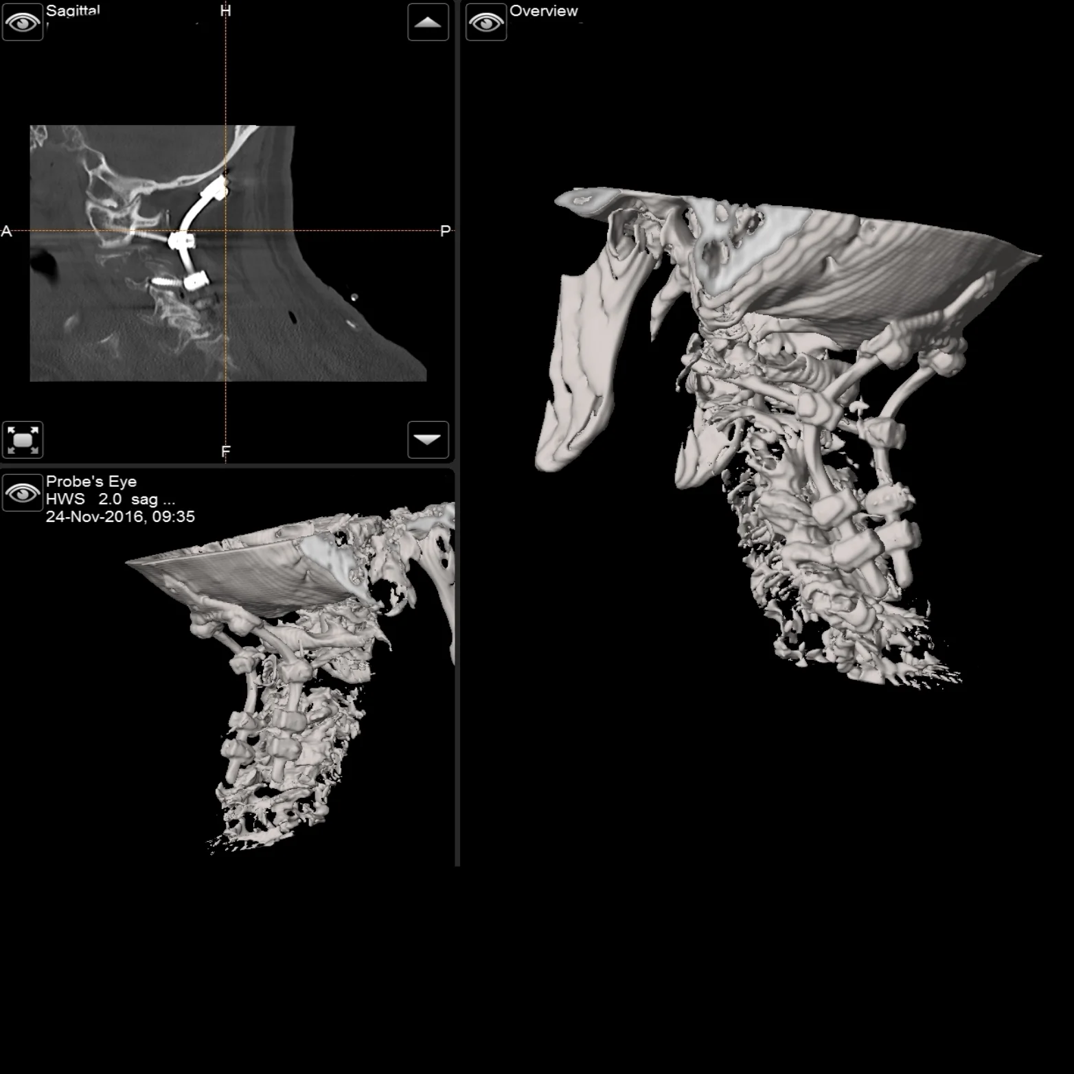 Intraoperative 2D und 3D Darstellung eines Patienten vor und nach kraniozervikaler Fusion mittels eines Schrauben-Stab-Systems