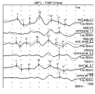Beispiel einer AEP Untersuchung